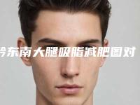 黔东南大腿吸脂减肥图对比整形的特点是什么价格要多少钱